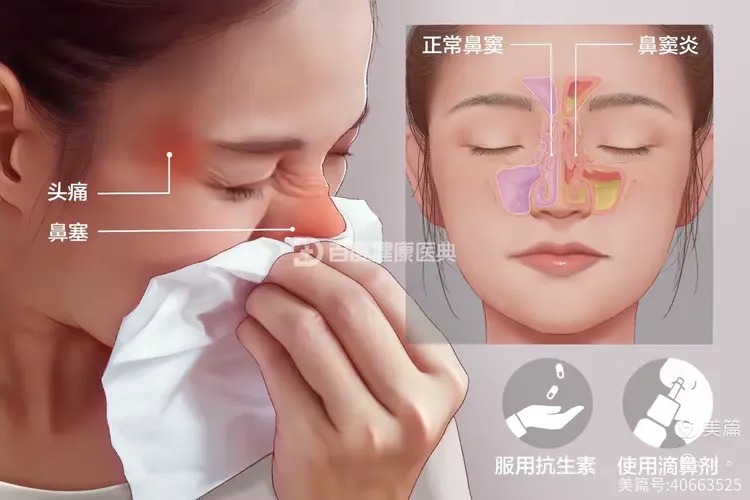 畅享呼吸之“鼻窦炎”